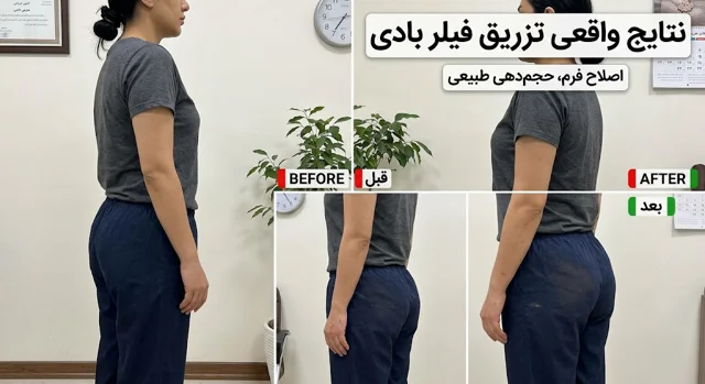 فیلر بادی