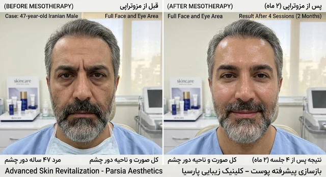 Mesotherapy