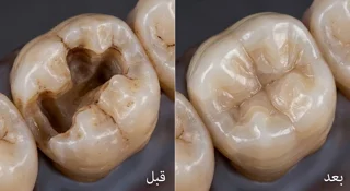 ترمیم سه سطحی دندان