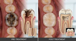Single-canal root canal treatment (with restoration)