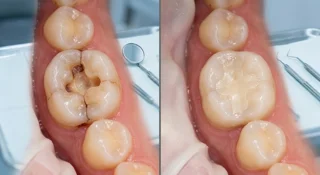 Two-canal root canal treatment (with restoration)